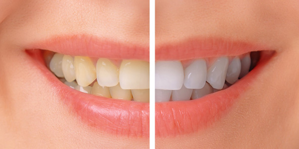 benefits-of--teeth-whitened